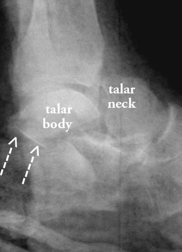 Talar Neck Fractures - Trauma - Orthobullets